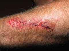 open wound open wound