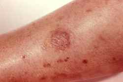 spider bite spider bite